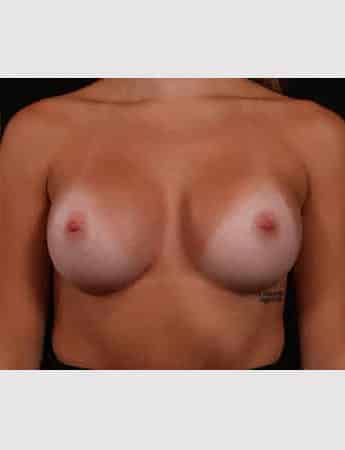 After Image: Breast Augmentation - front