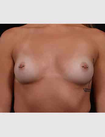 Before Image: Breast Augmentation - front
