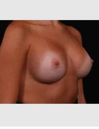 After Image: Breast Augmentation - right-front-oblique