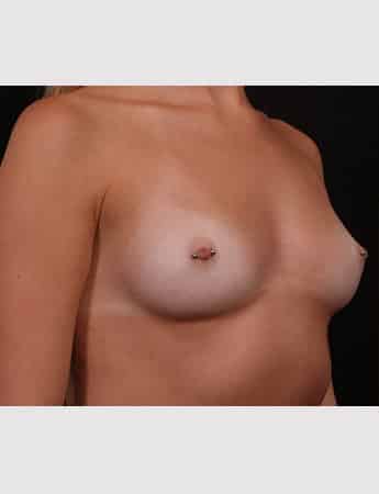 Before Image: Breast Augmentation - right-front-oblique