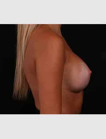 After Image: Breast Augmentation - right-side