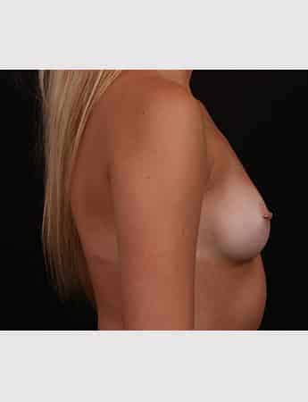 Before Image: Breast Augmentation - right-side