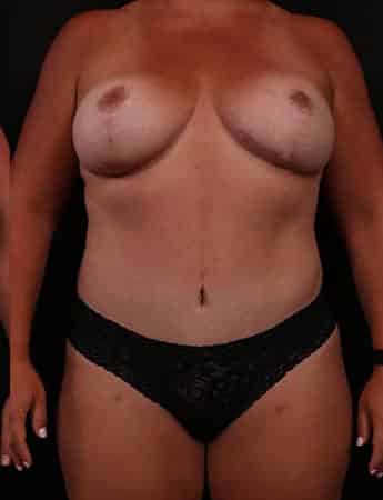 After Image: Mommy Makeover - front