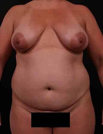 Before Image: Mommy Makeover - front