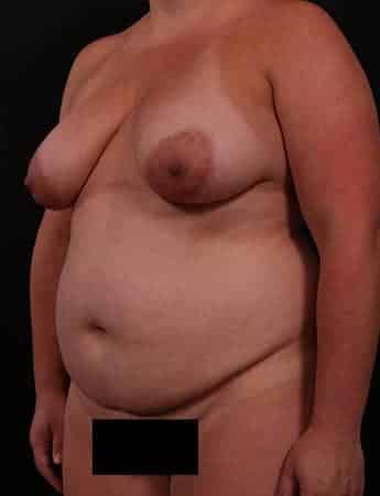 Before Image: Mommy Makeover - left-front-oblique