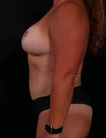 After Image: Mommy Makeover - left-side