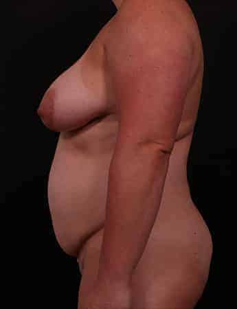 Before Image: Mommy Makeover - left-side
