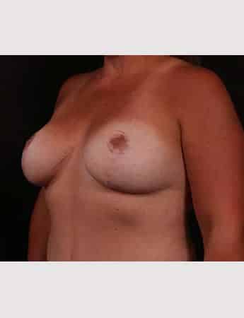 After Image: Mastopexy (Breast Lift) - left-front-oblique