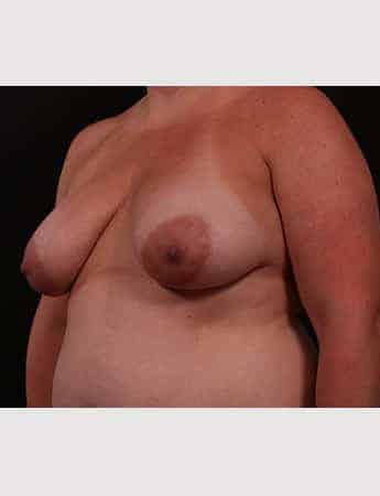 Before Image: Mastopexy (Breast Lift) - left-front-oblique