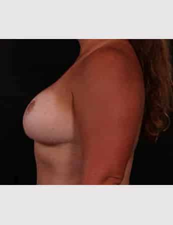 After Image: Mastopexy (Breast Lift) - left-side