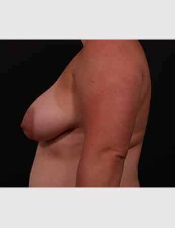 Before Image: Mastopexy (Breast Lift) - left-side