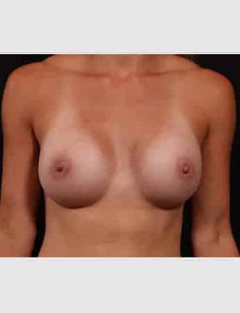 After Image: Breast Augmentation - front