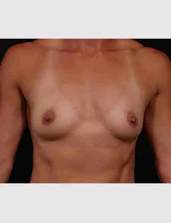 Before Image: Breast Augmentation - front