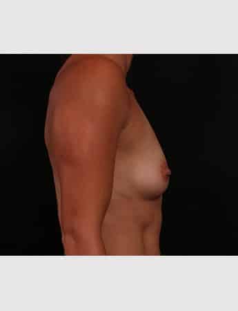 Before Image: Breast Augmentation - right-side