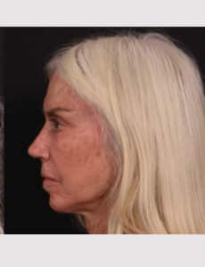 After Image: Revision Rhinoplasty