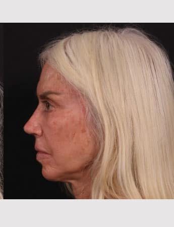 After Image: Revision Rhinoplasty - left-side