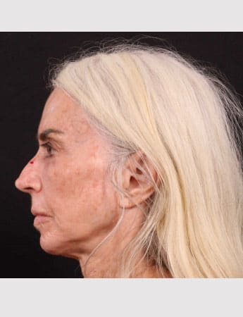 Before Image: Revision Rhinoplasty - left-side