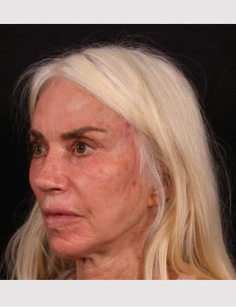 After Image: Revision Rhinoplasty - left-front-oblique