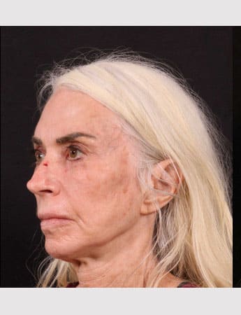 Before Image: Revision Rhinoplasty - left-front-oblique