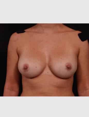 After Image: Secondary Breast Surgery - front