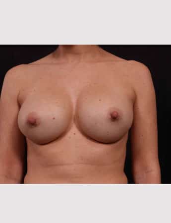 Before Image: Secondary Breast Surgery - front