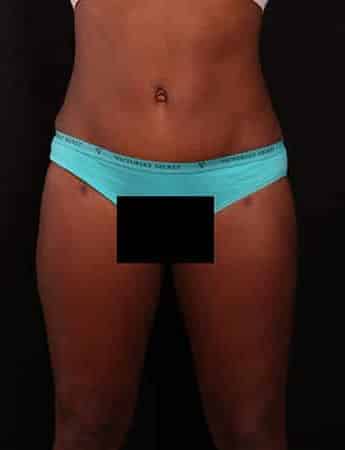 After Image: Tummy Tuck (Abdominoplasty) - front