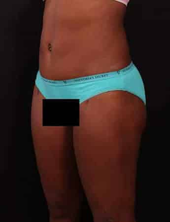 After Image: Tummy Tuck (Abdominoplasty) - left-front-oblique