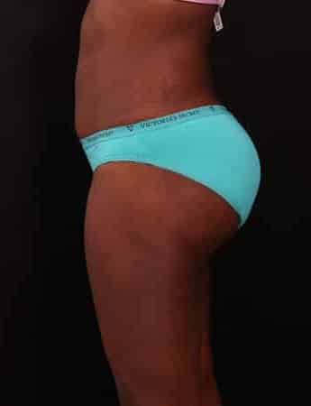 After Image: Tummy Tuck (Abdominoplasty) - left-side