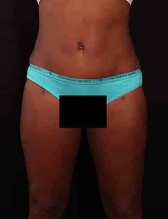 After Image: Tummy & Outer Thigh Liposuction - front