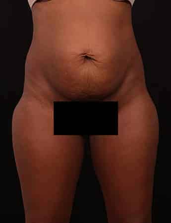 Tummy & Outer Thigh Liposuction