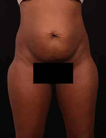 Before Image: Tummy & Outer Thigh Liposuction - front