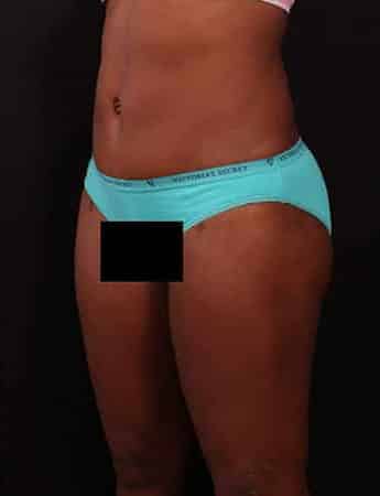 After Image: Tummy & Outer Thigh Liposuction - left-front-oblique