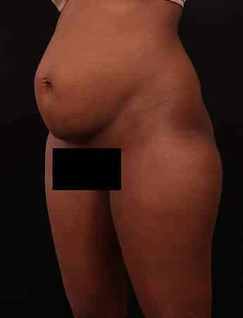 Before Image: Tummy & Outer Thigh Liposuction - left-front-oblique