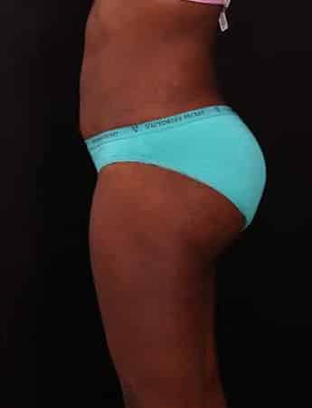 After Image: Tummy & Outer Thigh Liposuction - left-side