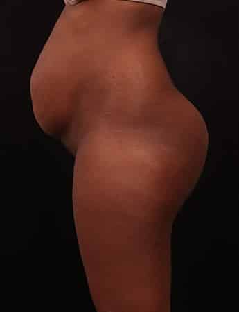 Before Image: Tummy & Outer Thigh Liposuction - left-side