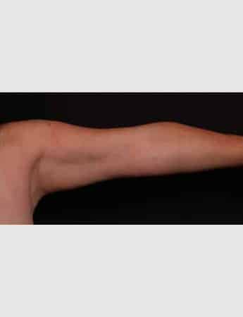 Before Image: Arm Liposuction - front