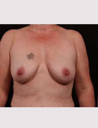 Before Image: Breast Lift (Mastopexy) with Augmentation - front