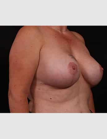 After Image: Breast Lift (Mastopexy) with Augmentation - right-front-oblique