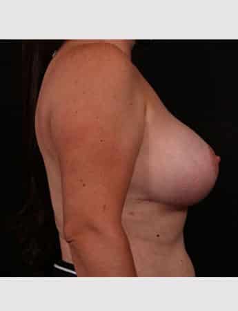 After Image: Breast Lift (Mastopexy) with Augmentation - right-side