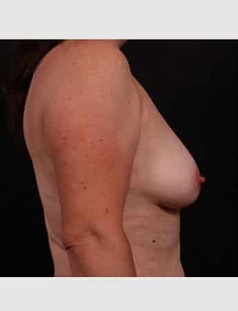 Before Image: Breast Lift (Mastopexy) with Augmentation - right-side