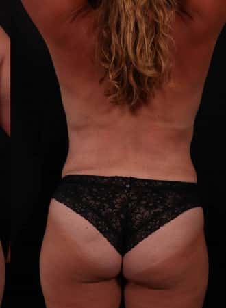 After Image: Liposuction - back