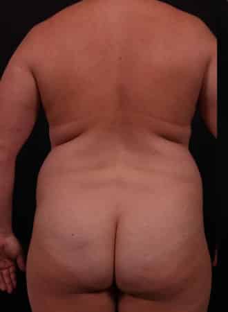 Before Image: Liposuction - back