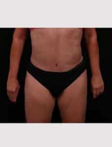 After Image: Revision Abdominoplasty