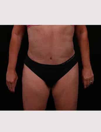 After Image: Revision Abdominoplasty - front