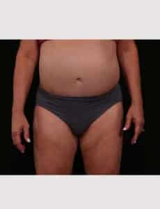 Before Image: Revision Abdominoplasty