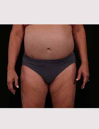Before Image: Revision Abdominoplasty - front