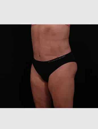 After Image: Revision Abdominoplasty - left-front-oblique