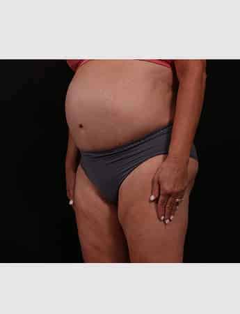 Before Image: Revision Abdominoplasty - left-front-oblique