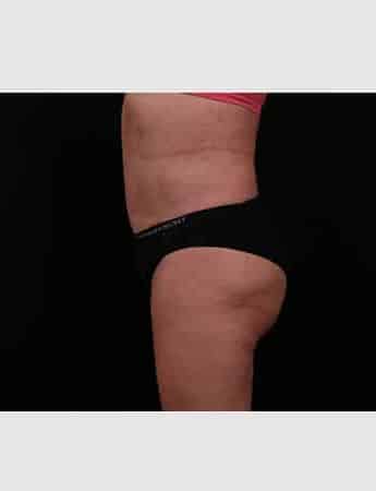 After Image: Revision Abdominoplasty - left-side