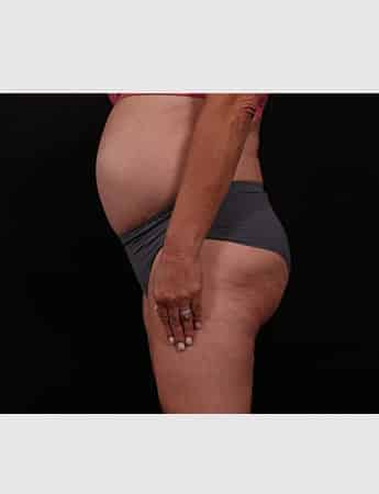 Before Image: Revision Abdominoplasty - left-side
